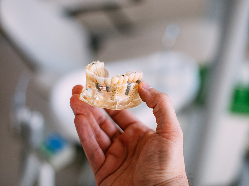 How Do I Care for My All-on-4 Dental Implants See Me Smile Dental in Oxnard CA