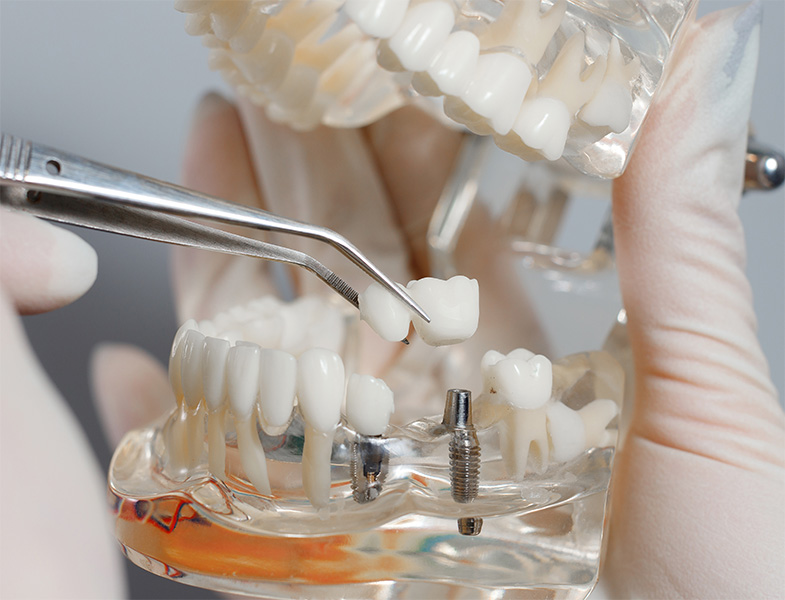 What Types of Dental Implants Does See Me Smile Dental of Oxnard Offer See Me Smile Dental in Oxnard CA