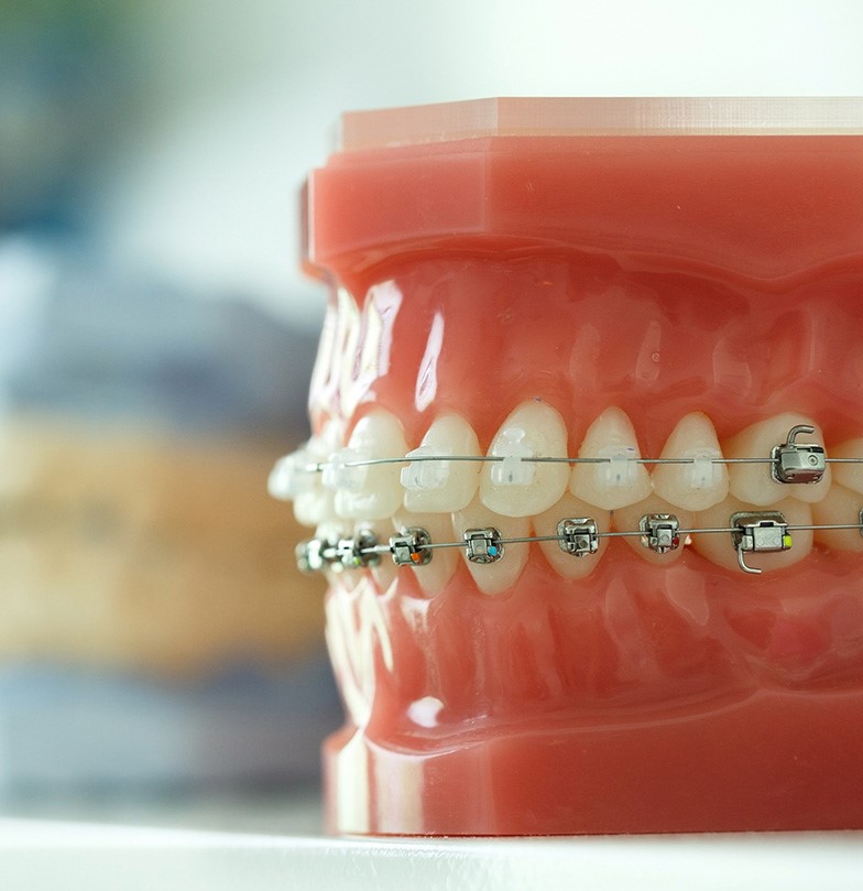 https://dentistoxnard.com/img/porcelain-ceramic-braces/are-metal-braces-better-than-porcelain-ceramic-braces-see-me-smile-dental-oxnard-ca.jpg