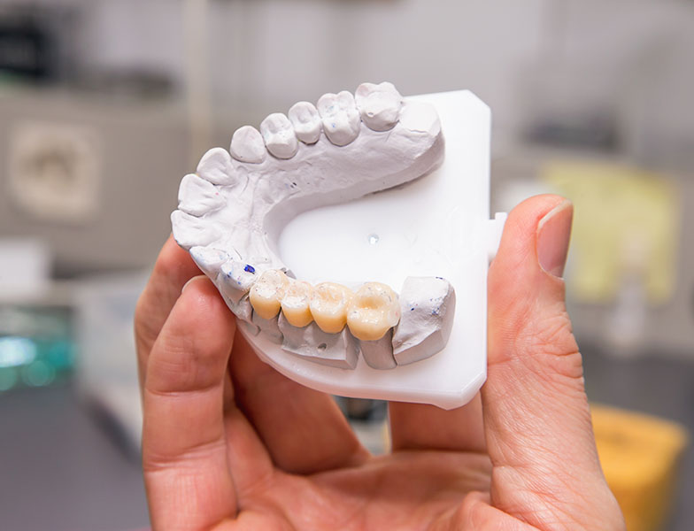 What Type of Dental Bridge Should I Get See Me Smile Dental Oxnard CA