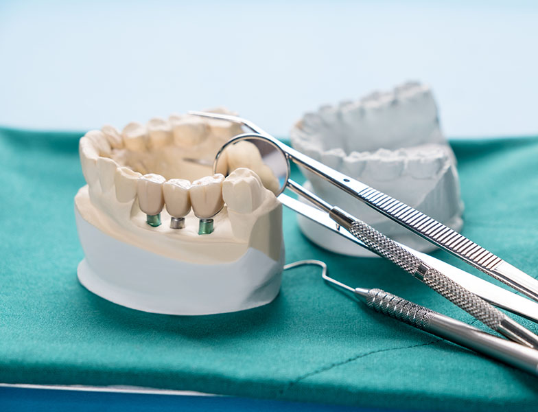 What Is a Porcelain Fixed Bridge See Me Smile Dental Oxnard CA Image